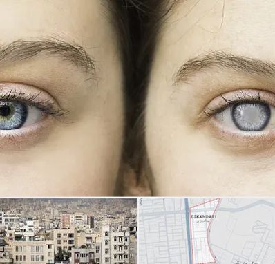 متخصص آب سیاه (گلوکوم) در اسکندری