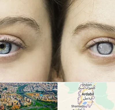 متخصص آب سیاه (گلوکوم) در اردبیل