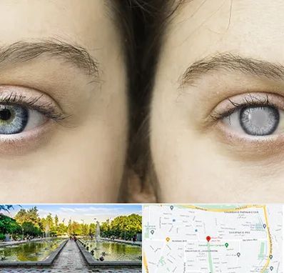 متخصص آب سیاه (گلوکوم) در سرسبز 