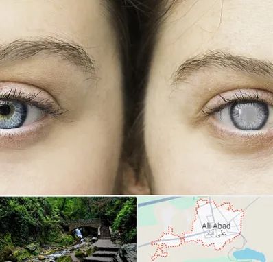 متخصص آب سیاه (گلوکوم) در علی آباد کتول