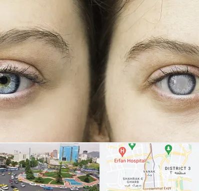 متخصص آب سیاه (گلوکوم) در ونک 