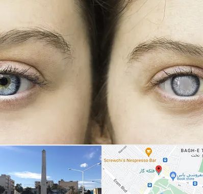 متخصص آب سیاه (گلوکوم) در فلکه گاز شیراز