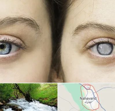 متخصص آب سیاه (گلوکوم) در نهاوند