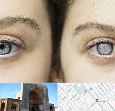 متخصص آب سیاه (گلوکوم) در مصلی مشهد