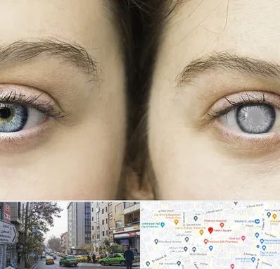 متخصص آب سیاه (گلوکوم) در فاطمی 