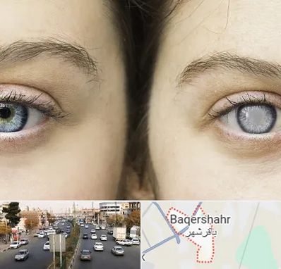 متخصص آب سیاه (گلوکوم) در باقرشهر