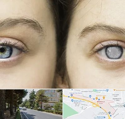 متخصص آب سیاه (گلوکوم) در مهرویلا کرج