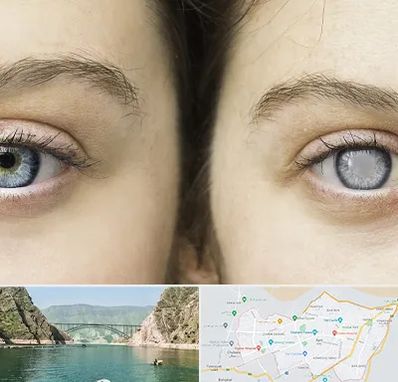 متخصص آب سیاه (گلوکوم) در ایلام