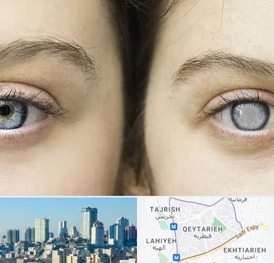 متخصص آب سیاه (گلوکوم) در قیطریه 