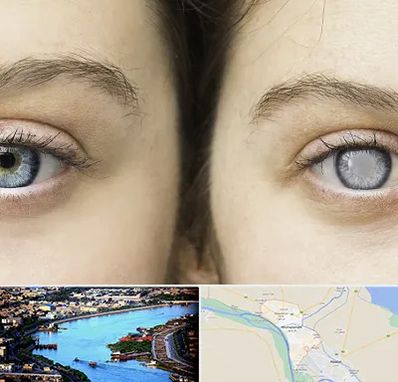 متخصص آب سیاه (گلوکوم) در خرمشهر