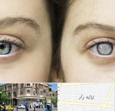 متخصص آب سیاه (گلوکوم) در لاله زار