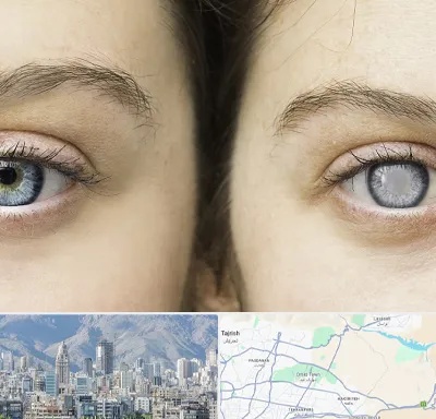 متخصص آب سیاه (گلوکوم) در شمال شرق تهران