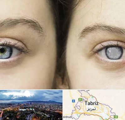 متخصص آب سیاه (گلوکوم) در تبریز