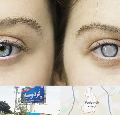 متخصص آب سیاه (گلوکوم) در فردوسیه شهریار