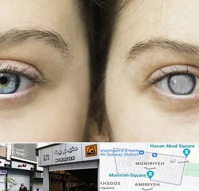 متخصص آب سیاه (گلوکوم) در منیریه 