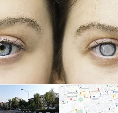 متخصص آب سیاه (گلوکوم) در میدان کاج 