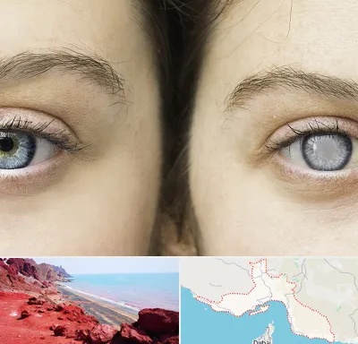 متخصص آب سیاه (گلوکوم) در هرمزگان