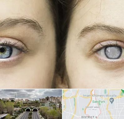 متخصص آب سیاه (گلوکوم) در یوسف آباد 