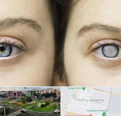 متخصص آب سیاه (گلوکوم) در تهرانسر 