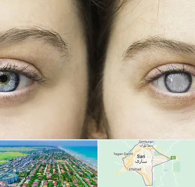 متخصص آب سیاه (گلوکوم) در ساری