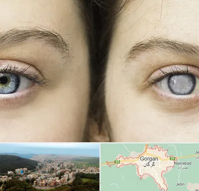 متخصص آب سیاه (گلوکوم) در گرگان