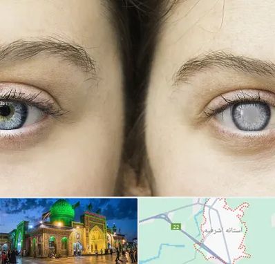 متخصص آب سیاه (گلوکوم) در آستانه اشرفیه