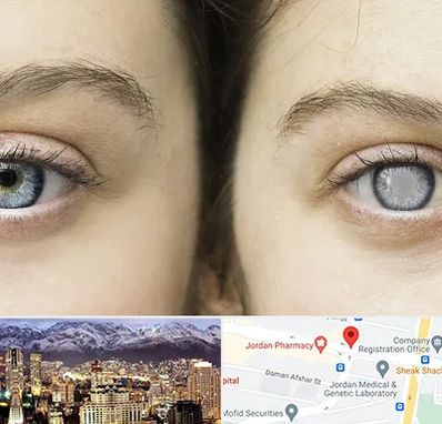 متخصص آب سیاه (گلوکوم) در جردن 