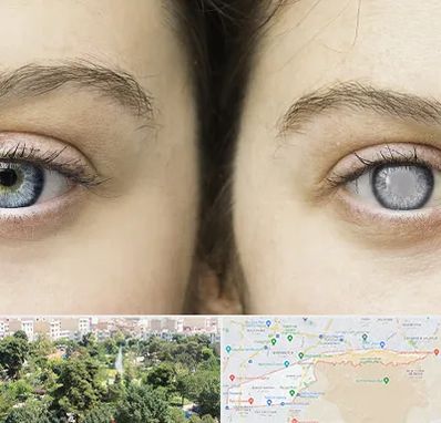 متخصص آب سیاه (گلوکوم) در منطقه 13 تهران 