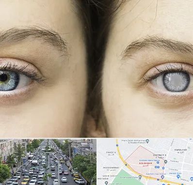 متخصص آب سیاه (گلوکوم) در گلشهر کرج