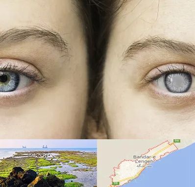 متخصص آب سیاه (گلوکوم) در بندرلنگه