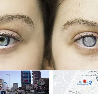 متخصص آب سیاه (گلوکوم) در چهارراه طالقانی کرج