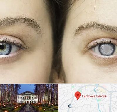 متخصص آب سیاه (گلوکوم) در باغ فردوس