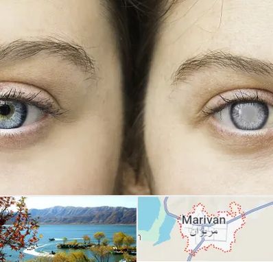متخصص آب سیاه (گلوکوم) در مریوان