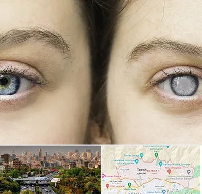 متخصص آب سیاه (گلوکوم) در منطقه 1 تهران 