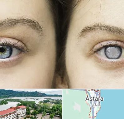 متخصص آب سیاه (گلوکوم) در آستارا