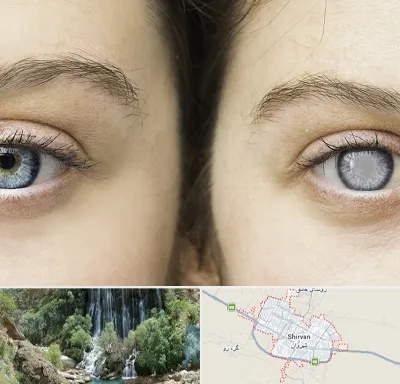 متخصص آب سیاه (گلوکوم) در شیروان