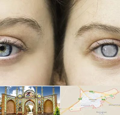 متخصص آب سیاه (گلوکوم) در سمنان