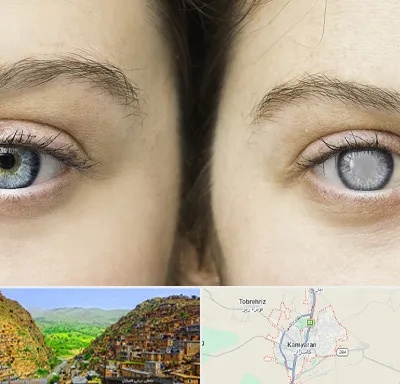 متخصص آب سیاه (گلوکوم) در کامیاران