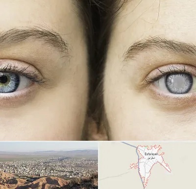 متخصص آب سیاه (گلوکوم) در اسفراین