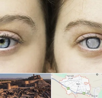 متخصص آب سیاه (گلوکوم) در بم