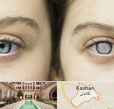 متخصص آب سیاه (گلوکوم) در کاشان