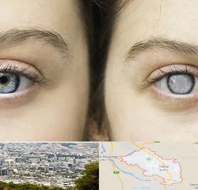 متخصص آب سیاه (گلوکوم) در یاسوج