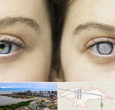 متخصص آب سیاه (گلوکوم) در بندر ترکمن