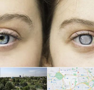 متخصص آب سیاه (گلوکوم) در منطقه 16 تهران 