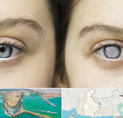 متخصص آب سیاه (گلوکوم) در سیستان و بلوچستان