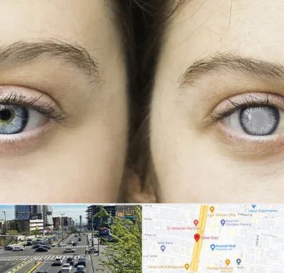 متخصص آب سیاه (گلوکوم) در ستاری 