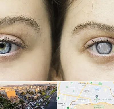 متخصص آب سیاه (گلوکوم) در تهرانپارس 