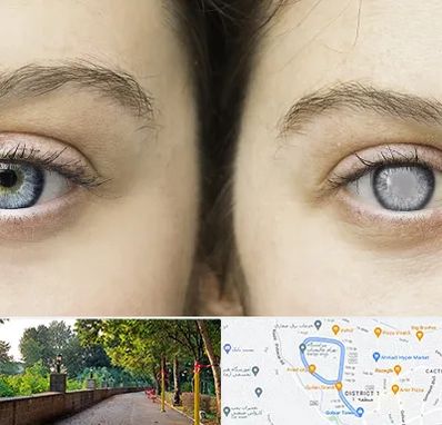 متخصص آب سیاه (گلوکوم) در فلکه گاز رشت