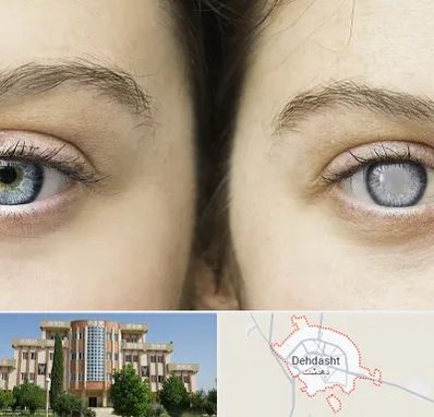 متخصص آب سیاه (گلوکوم) در دهدشت