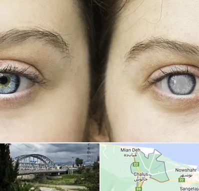 متخصص آب سیاه (گلوکوم) در چالوس